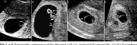 can an enlarged yolk sac correct itself|Understanding how 4 abnormal ultrasound findings .